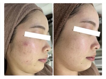 ホワイトアクア 浜松店(WHITE AQUA)/ハーブピーリング/ニキビケア