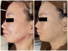 キレイ(KIREI)/before　＆　after