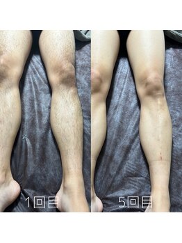 カナウ(KANAU)/脚脱毛（20代前半男性）