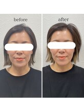 リノア 堀江(Linoa)/小顔矯正施術前後写真