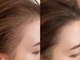 ワンドロップキートス(one drop kiitos)の写真/【プロセルセラピーズ】秋田に上陸!米国皮膚科と提携マイクロチャネリング!98％が実感するスピード育毛促進