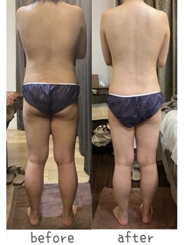トモズサロン28(Tomos.salon.)/セル脂肪撃退！