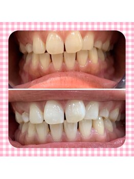 カシワビューティーココ(kashiwa beauty coco)/セルフホワイトニング