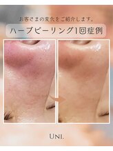ユニ(uni.)/ハーブピーリング