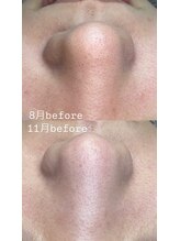 プラスボーテ 幡ヶ谷(plus beaute)/毛穴エクストラクション/北参道