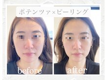 LINO SHONAN鍼灸salon【ポテンツァ・美容鍼・整体・ヘッドスパ】【1月OPEN（予定）】の雰囲気（ダウンタイムもなく、感動の変化を提供致します。）