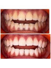 コナホワイトニング 神保町/クリーニングとホワイトニング