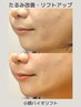 【筋膜リフトアップ】圧倒的効果◎小顔バイオリフト
