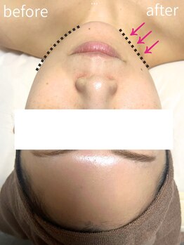 リフト 西船橋(Lift)/オンダリフト/Before/After