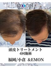アンドエモン(&EMON)/【頭皮】プロセル効果