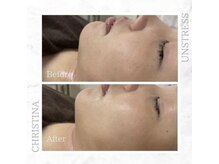 シャルムパリス(charme paris)/透明感アップ☆１回の施術変化