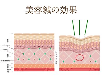 ゲンキ鍼灸整骨院(Genki鍼灸整骨院)/美容鍼の効果