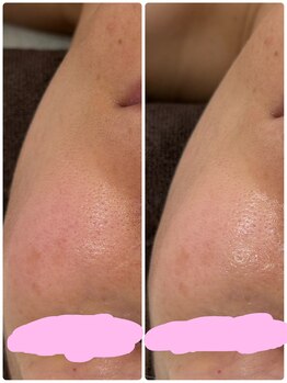 ギャラクシービューティー(galaxy beauty)/ララピールで透明感