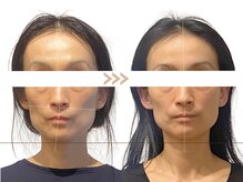 メラリノ(Melalino)/シンメトリー小顔×内臓整美SET