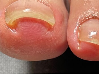 ラピス(Lapis)の写真/【爪トラブルを徹底改善】歩くのも辛い巻爪とはおさらば☆即日歩行可能！丁寧にカウンセリングいたします♪