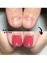 プラスワン(+1)/ハンド深爪矯正