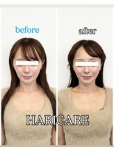 ハリケア 麻布十番院(HARICARE)/施術１回目のbefore after