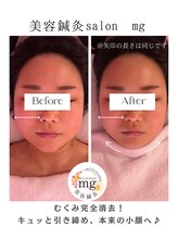 ミリグラム(mg)/【全身美容鍼灸９０分】