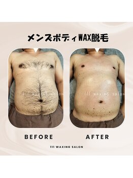 トリプルワン(111)/メンズボディWAX脱毛