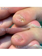 巻き爪補正店 久留米店/副爪