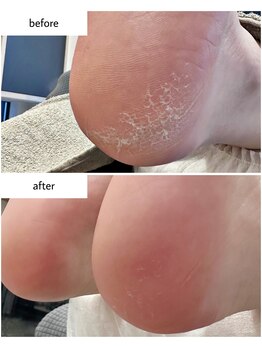 ケアプラス(care plus)/足裏角質ケア