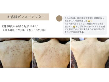 エミルカ 北谷店(EMILUCA)/ハーブピーリングでお悩み改善