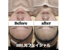 クレア(Claire)/BBL光フェイシャル