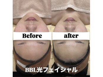 クレア(Claire)/BBL光フェイシャル
