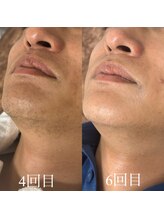 ランプ(LAMP)/～ハイブリッドヒゲ脱毛～