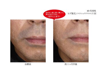 メンズ asc(men's asc)/脱毛