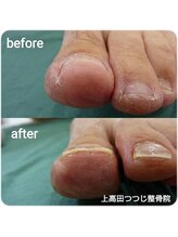 上高田つつじ整体院/巻き爪　ネイルケア　例　