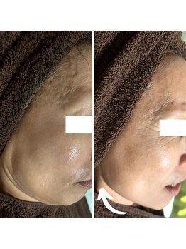 マーギアー(Magier)/ハーブ＋ダーマ　初来店施術前後