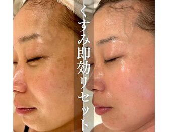 マインエム(mine.m)/VVSダイヤモンドピーリング