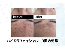リンフェイス 浦安店(RINFACE)の雰囲気（【リピ多数★】脱！いちご鼻ハイドラ洗浄&乳歯幹細胞導入）