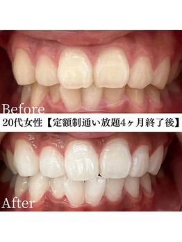 ホワイト 福岡天神店(WHITE)/ホワイトニングビフォーアフター