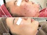 【再来★迷った方はこちら】フェイシャルニキビケアor背中ケア相談施術