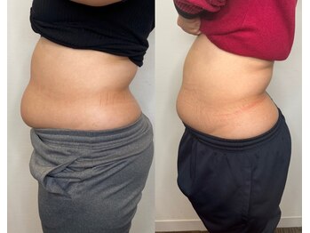 プルメリア(Plumeria)/初回撮影→中間撮影2