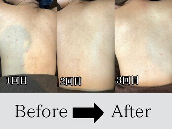 アノネ(Anone.)/美背中ハーブBefore After