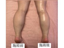 フェミニー(Feminy)/ふくらはぎ痩身も大人気！