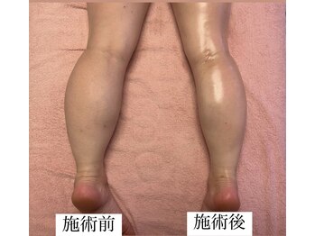 フェミニー(Feminy)/ふくらはぎ痩身も大人気！