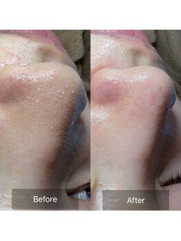 アネラ 難波(ANERA)/ハイドロスプラッシュ毛穴洗浄☆