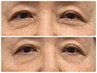 【眼精疲労・目元のお悩みに】グリーンピールeyeでお目元スッキリ30分￥7700