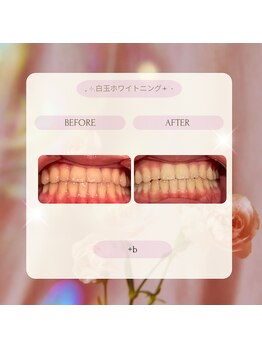 プラスビーセルフ(+b self)/ホワイトニングビフォーアフター