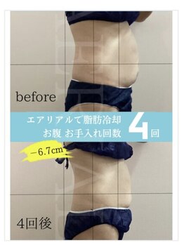 エアリアル 八代店/脂肪冷却　ワンサイズダウン♪