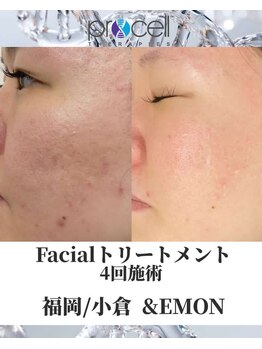 アンドエモン(&EMON)/【お顔】プロセル効果