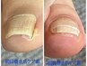 巻き爪ケア初回(両親指)¥13200