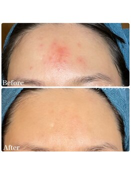 ちらちゅら/クリスティーナ【施術経過】