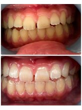 まつ毛エクステサロン キャトルママンズ(Quatre mamans)/セルフホワイトニング