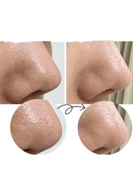 レミー(Remy)/毛穴エクストラクション