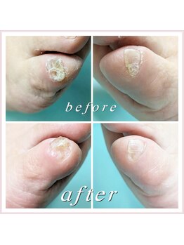 巻き爪補正店 大阪なんば店/副爪2箇所